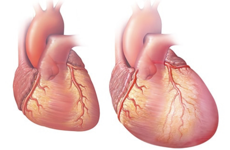 καρδιά ασθενούς με καρδιακή ανεπάρκεια που είναι αυξημένη σε μέγεθος