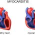 μυοκαρδίτιδα - φλεγμονή του καρδιακού μυός