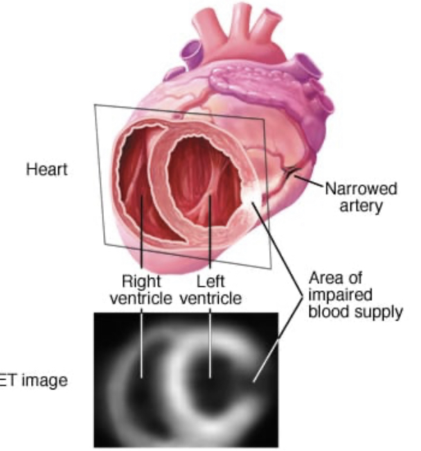 Τι μπορεί να βρει μια σάρωση PET καρδιάς