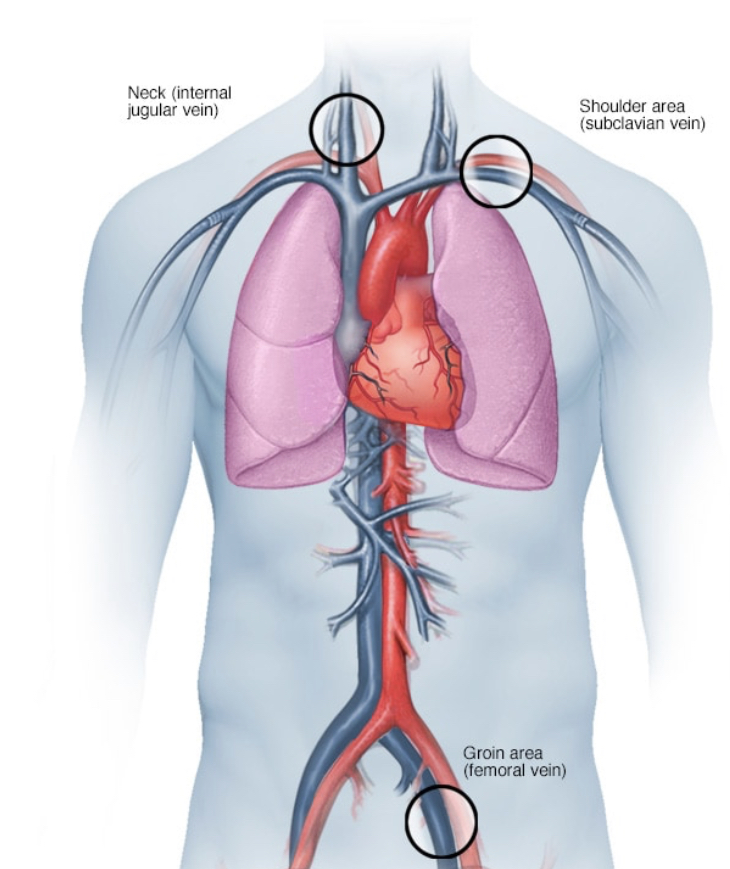καθετήρας μέσω ενός αιμοφόρου αγγείου στην καρδια