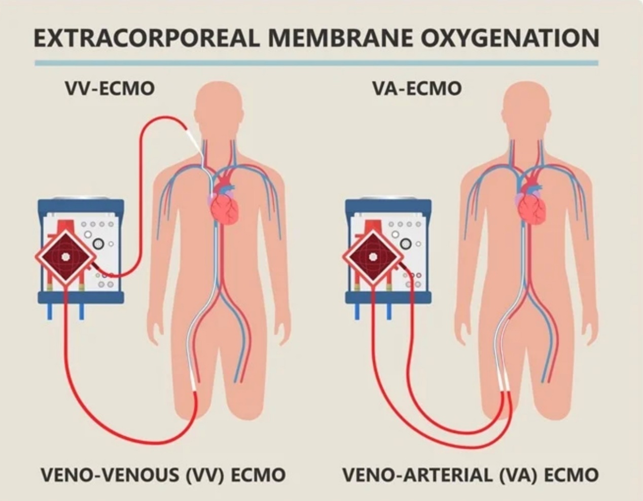 Εξωσωματική οξυγόνωση μεμβράνης (ECMO)