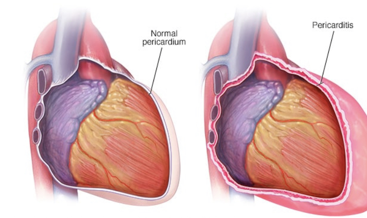 Μια καρδιά με περικαρδίτιδα (δεξιά) και μια φυσιολογική καρδιά (αριστερά)