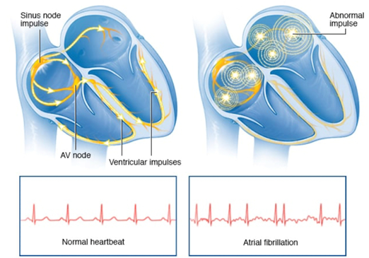 καρδιακός ρυθμός - Κολπική Μαρμαρυγή
