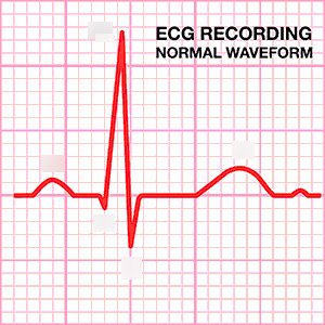 ηλεκτροκαρδιογράφημα (ΗΚΓ) ή καρδιογράφημα